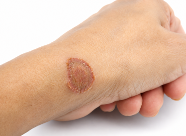 Why Does Ringworm Keep Coming Back? Causes and Prevention Tips Why Does Ringworm Keep Coming Back? Causes and Prevention Tips