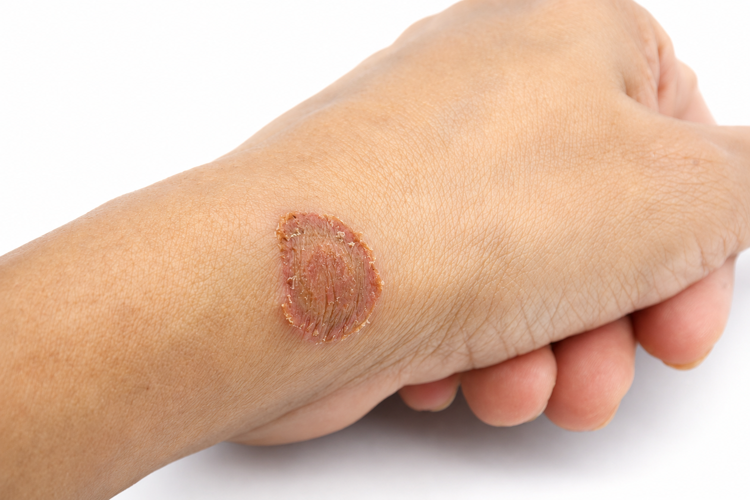 Why Does Ringworm Keep Coming Back? Causes and Prevention Tips