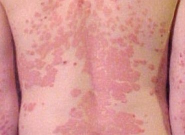 Psoriasis Treatment