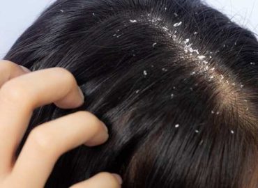 Dandruff Treatment