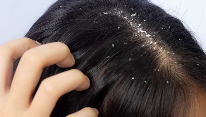 Anti-Dandruff Treatment for Scalp - Dr. Praneeth Clinic