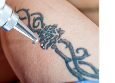 permanent tattoo removal in Hyderabad