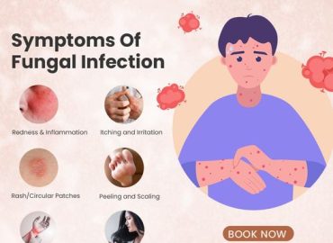 Fungal Infections