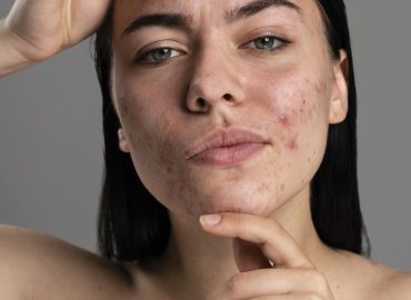 What causes acne in teenagers and adults explained
