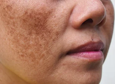 Black Patches on Face