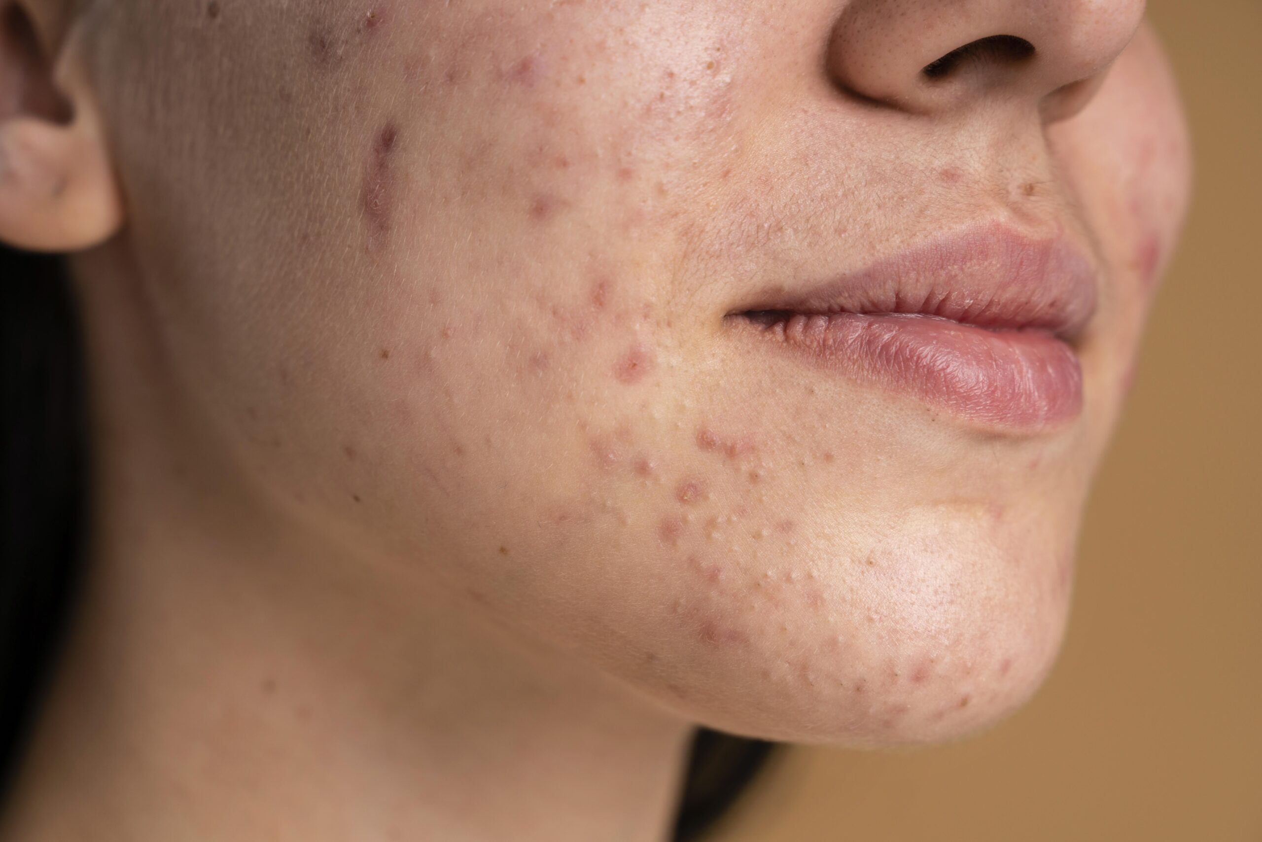 Black patches on face caused by hyperpigmentation