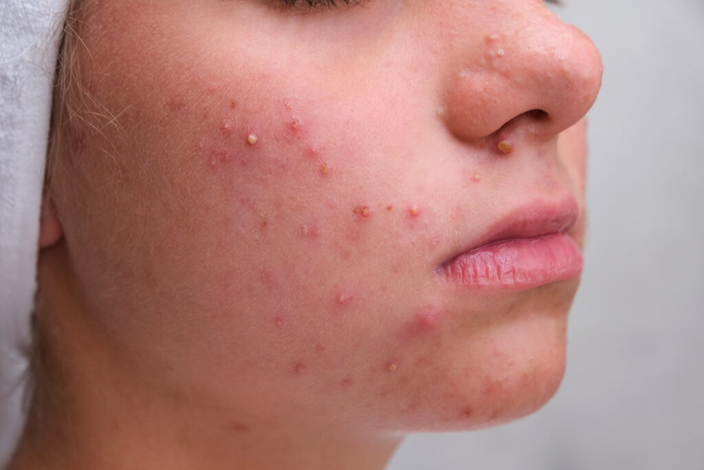 Teenage girl receiving dermatologist acne treatment in clinic