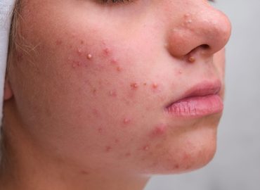 Teenage girl receiving dermatologist acne treatment in clinic