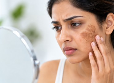 Dark Patches on Face Treatment - Dr Praneeth Dark patches on face caused by facial hyperpigmentation and pigmentation concerns