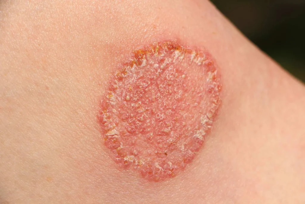 fungal infection causes, symptoms, treatment options, and prevention tips.