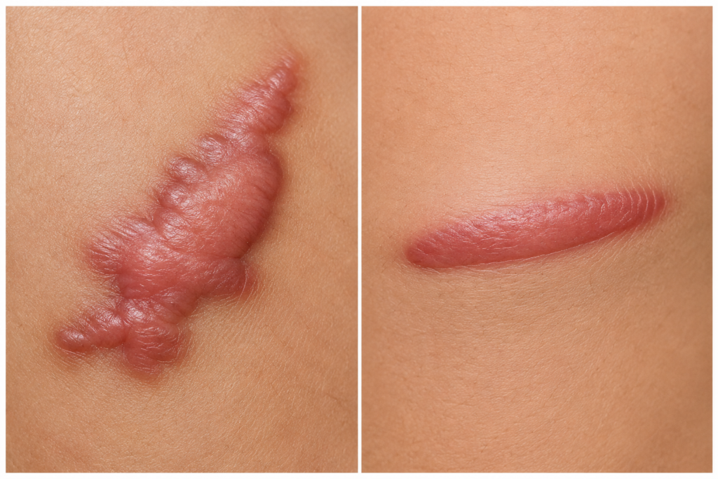 Keloid vs hypertrophic scar comparison showing a raised keloid extending beyond the wound and a hypertrophic scar staying within the wound.