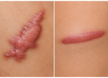Keloid vs Hypertrophic Scar Keloid vs hypertrophic scar comparison showing a raised keloid extending beyond the wound and a hypertrophic scar staying within the wound.