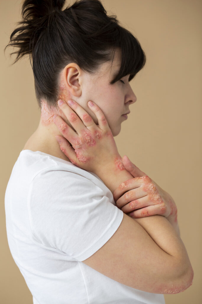 Psoriasis skin condition with red patches