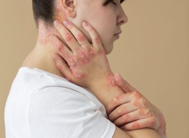Psoriasis skin condition with red patches