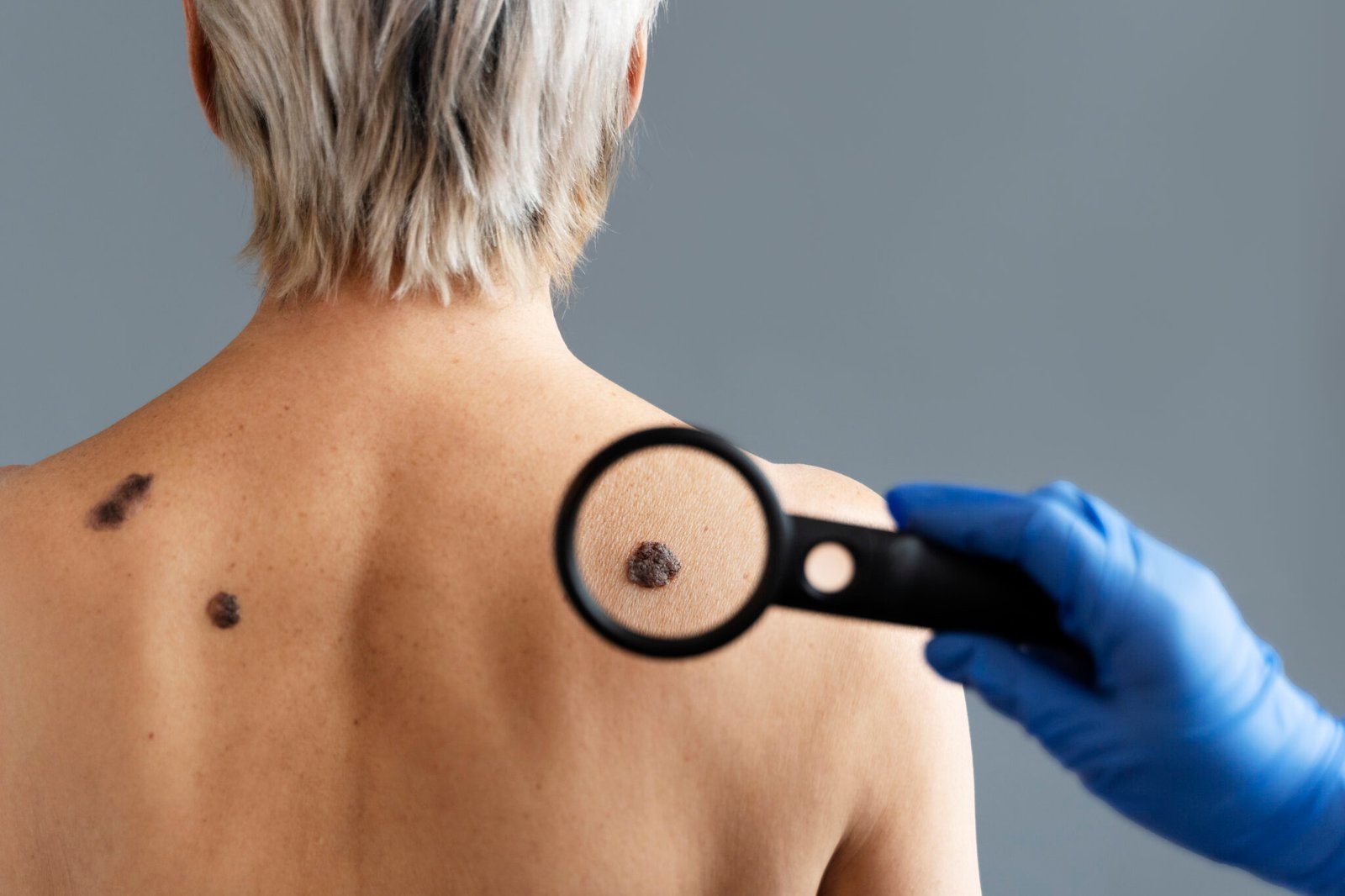 Skin Tags vs Warts vs Moles: Key Differences Explained