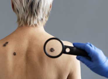 Understanding the visual differences between skin tags, warts, and moles.