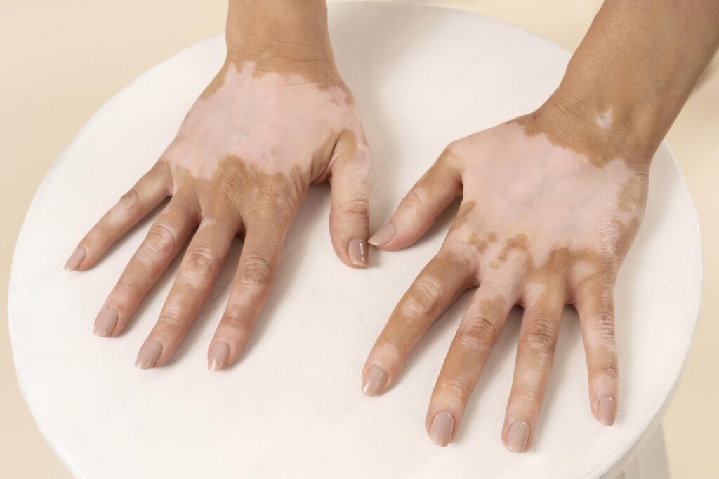 vitiligo treatment