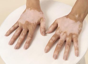 Vitiligo vitiligo treatment