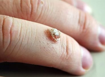 Safe and effective wart removal with electrocautery treatment for clear and healthy skin.