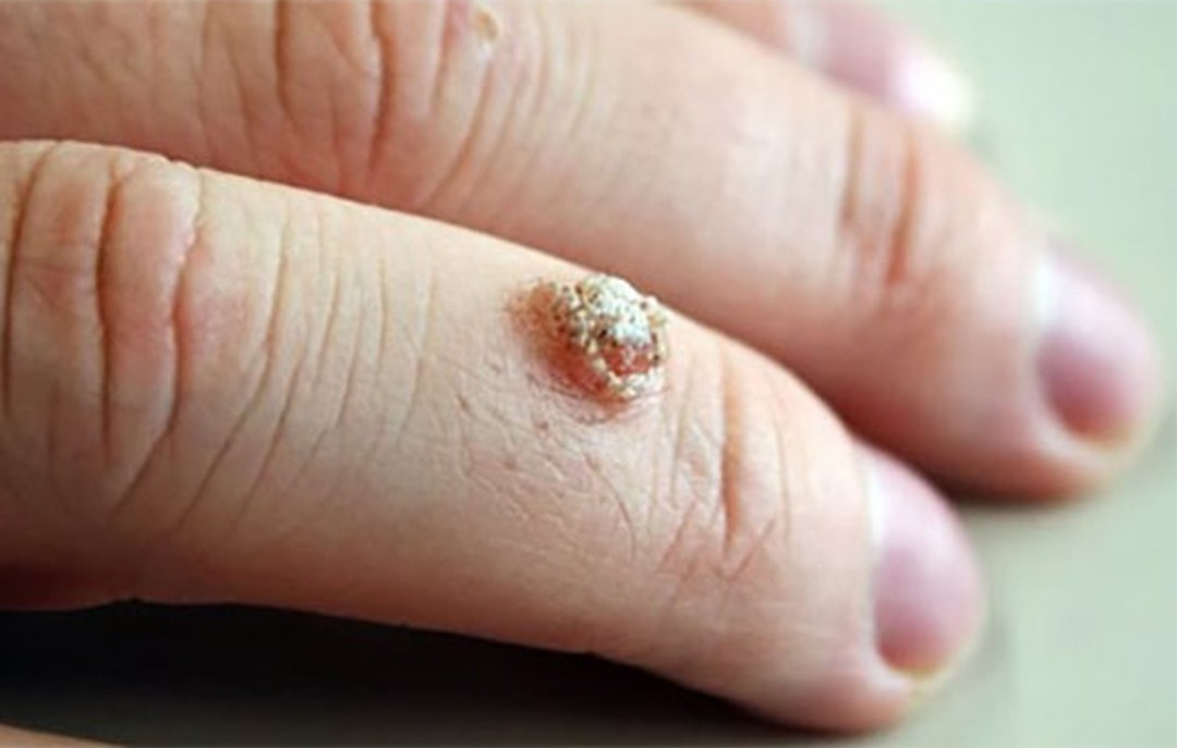 Dermatologist performing wart removal by electrocautery treatment