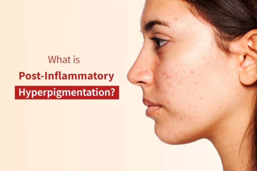 What is hyperpigmentation