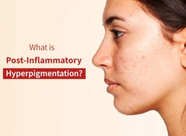 What is hyperpigmentation