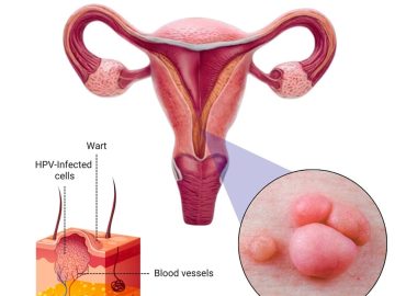 Genital warts symptoms and treatment
