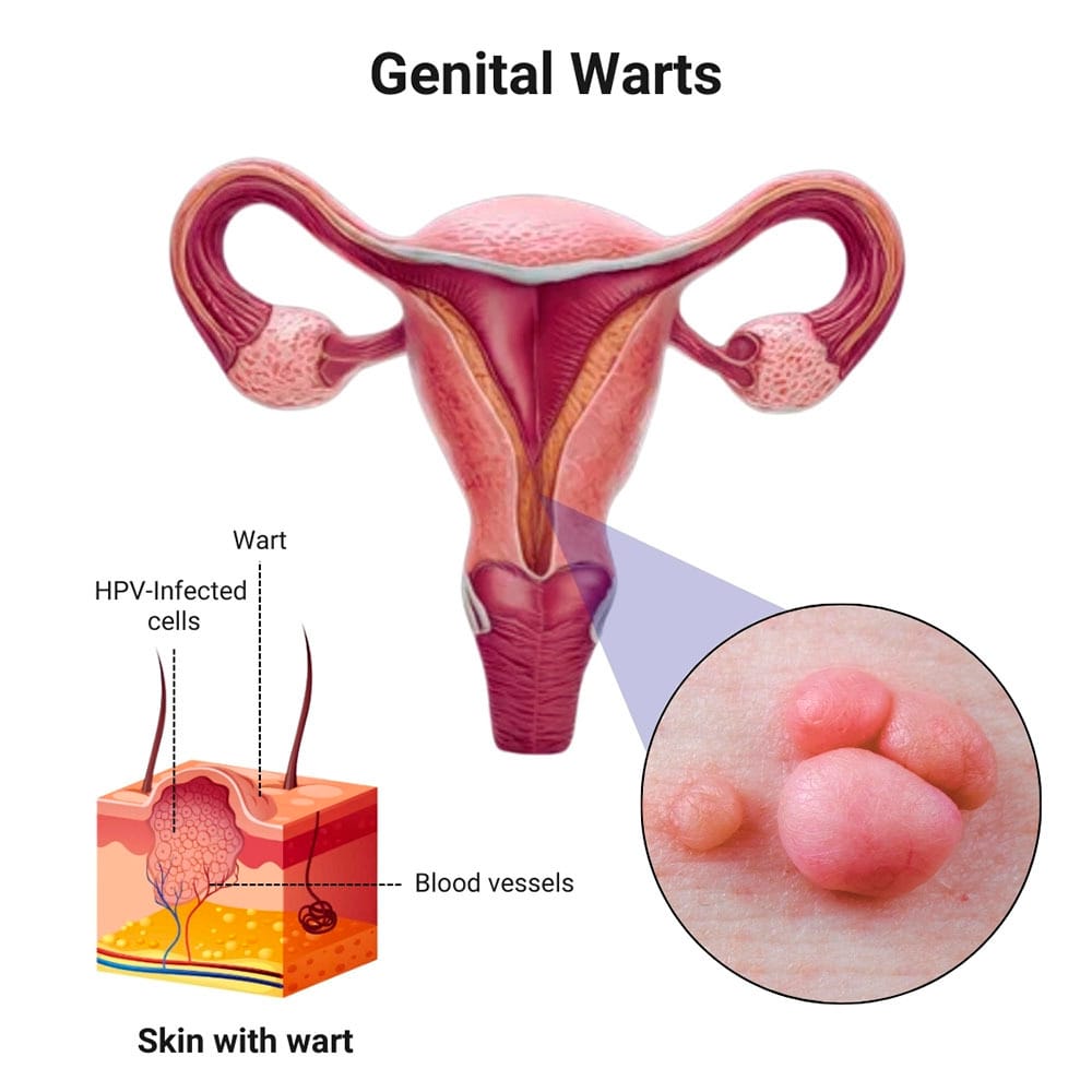 Genital warts symptoms and treatment