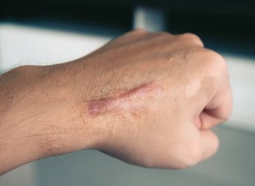 Keloid scar treated with intralesional corticosteroid injection