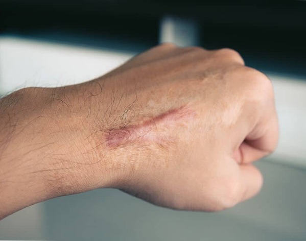 Keloid scar treated with intralesional corticosteroid injection