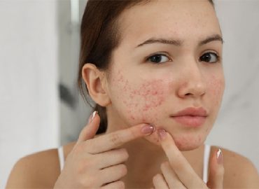 Causes of adult acne including hormones, stress, and skincare mistakes