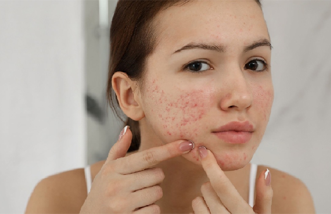 Causes of adult acne including hormones, stress, and skincare mistakes