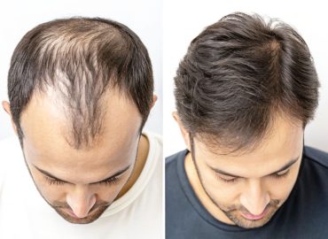 Before and after male pattern hair loss treatment showing improved hair density and restored hairline