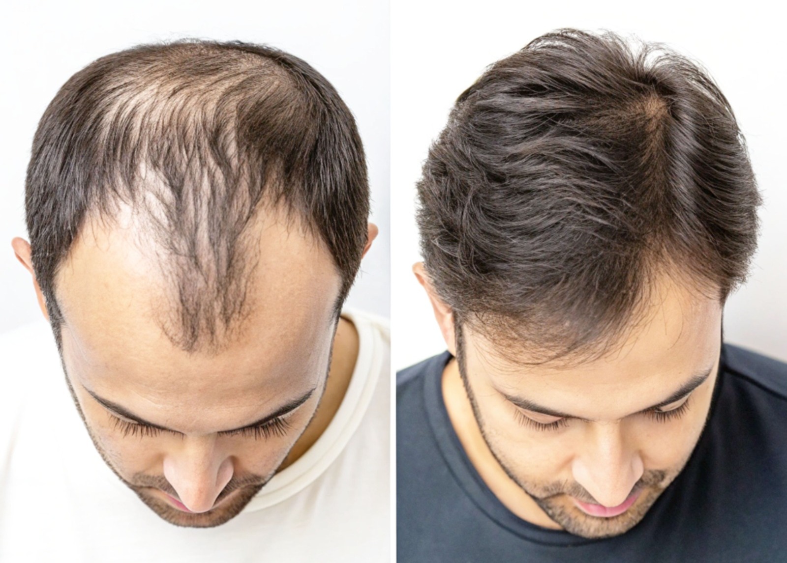 Before and after male pattern hair loss treatment showing improved hair density and restored hairline