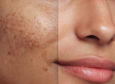 Best Dermatologist Recommended Treatments for Hyperpigmentation Best Dermatologist Recommended Treatments for Hyperpigmentation