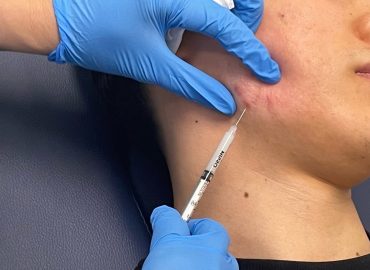 Intralesional Injection