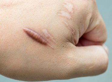 Scars