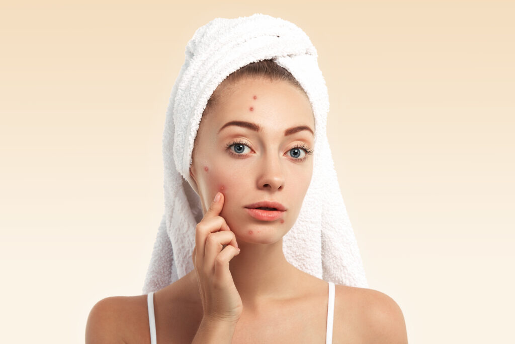 Woman receiving advanced acne scar treatment at a skincare clinic.