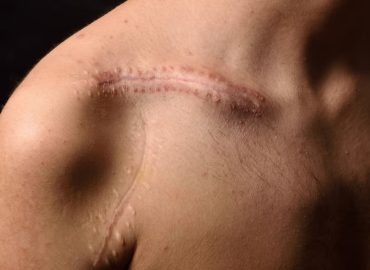 Keloid Scars