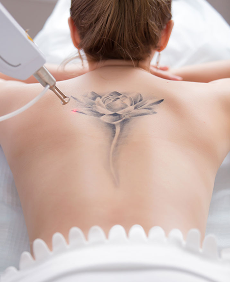 Laser tattoo Removal