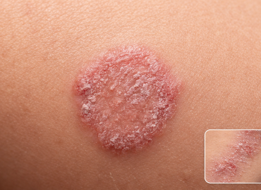 Fungal skin infections