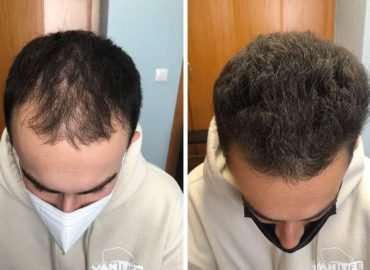 hair fall Hair Loss in Young Adults