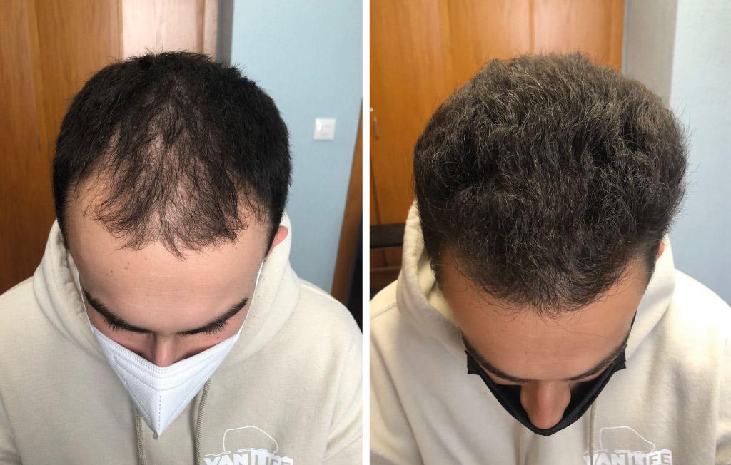 Hair Loss in Young Adults