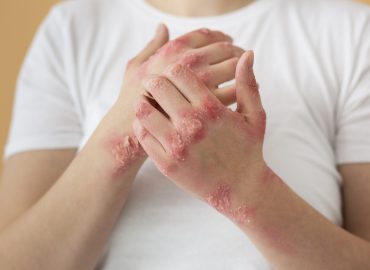Psoriasis treatment with NBUVB phototherapy for reducing red scaly skin patches