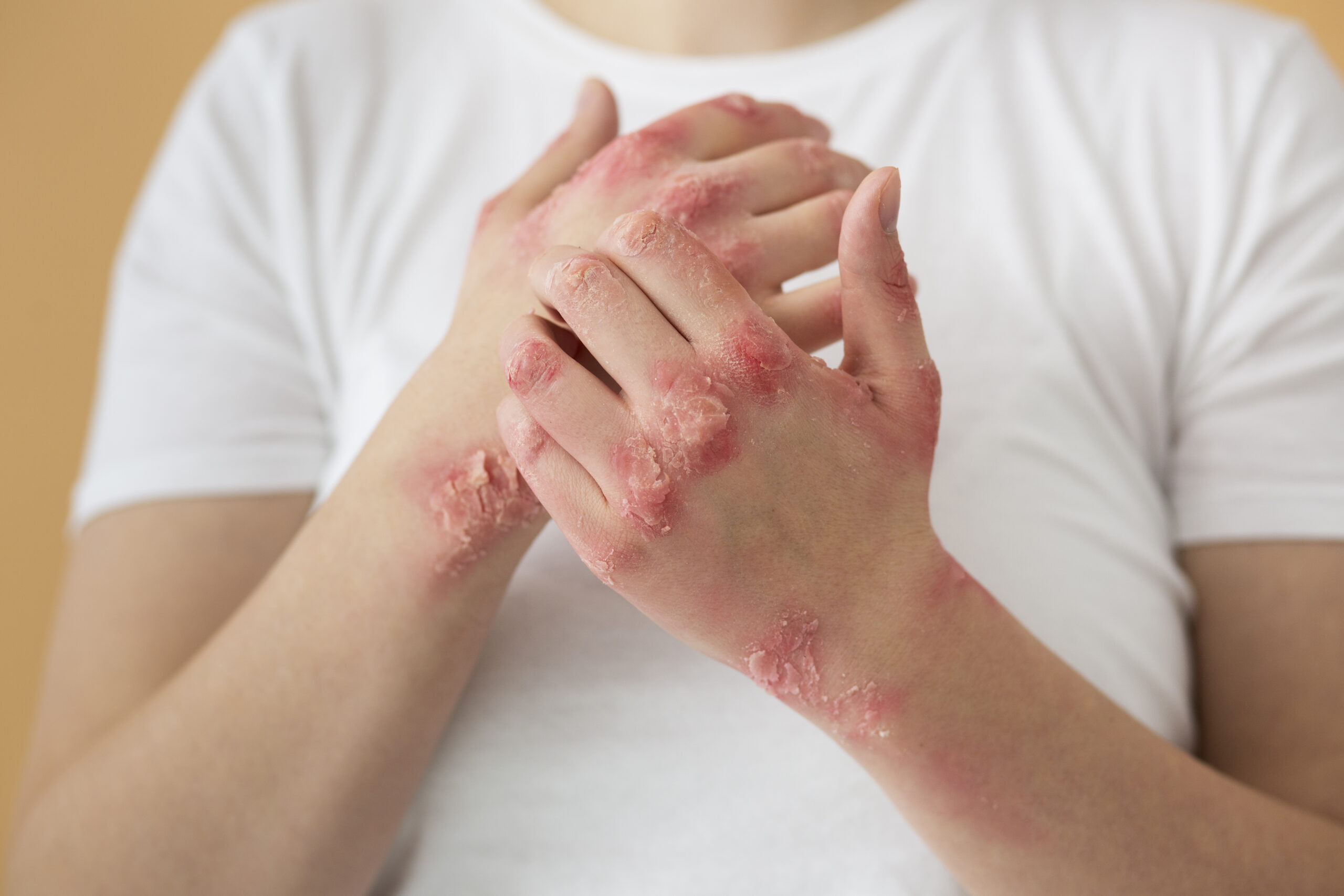 Psoriasis treatment with NBUVB phototherapy for reducing red scaly skin patches