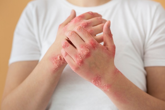 Fungal skin infections