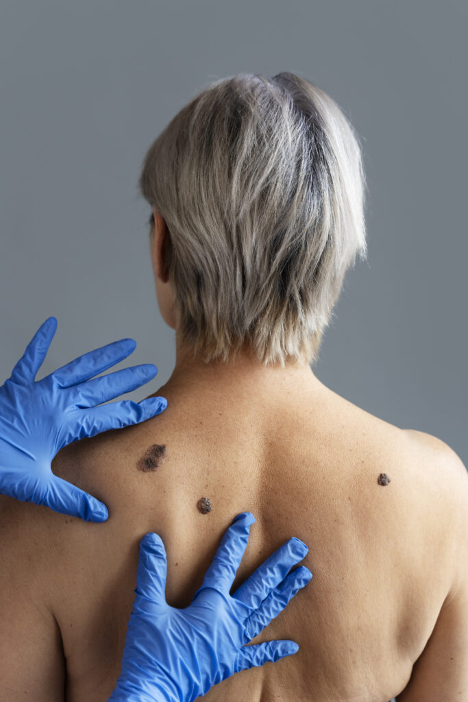 “laser wart removal KPHB”