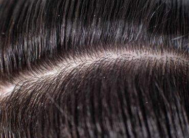 Hair Loss in men and women
