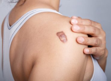 Keloid Scar