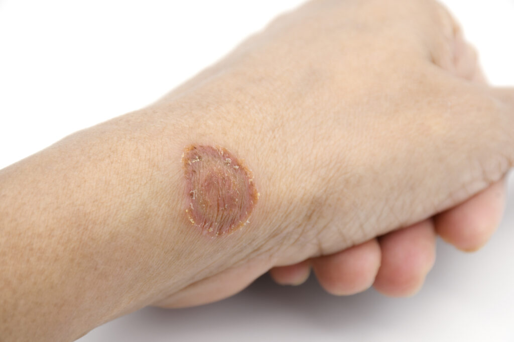 Dermatologist explaining why ringworm keeps coming back and how to prevent recurrent fungal skin infections